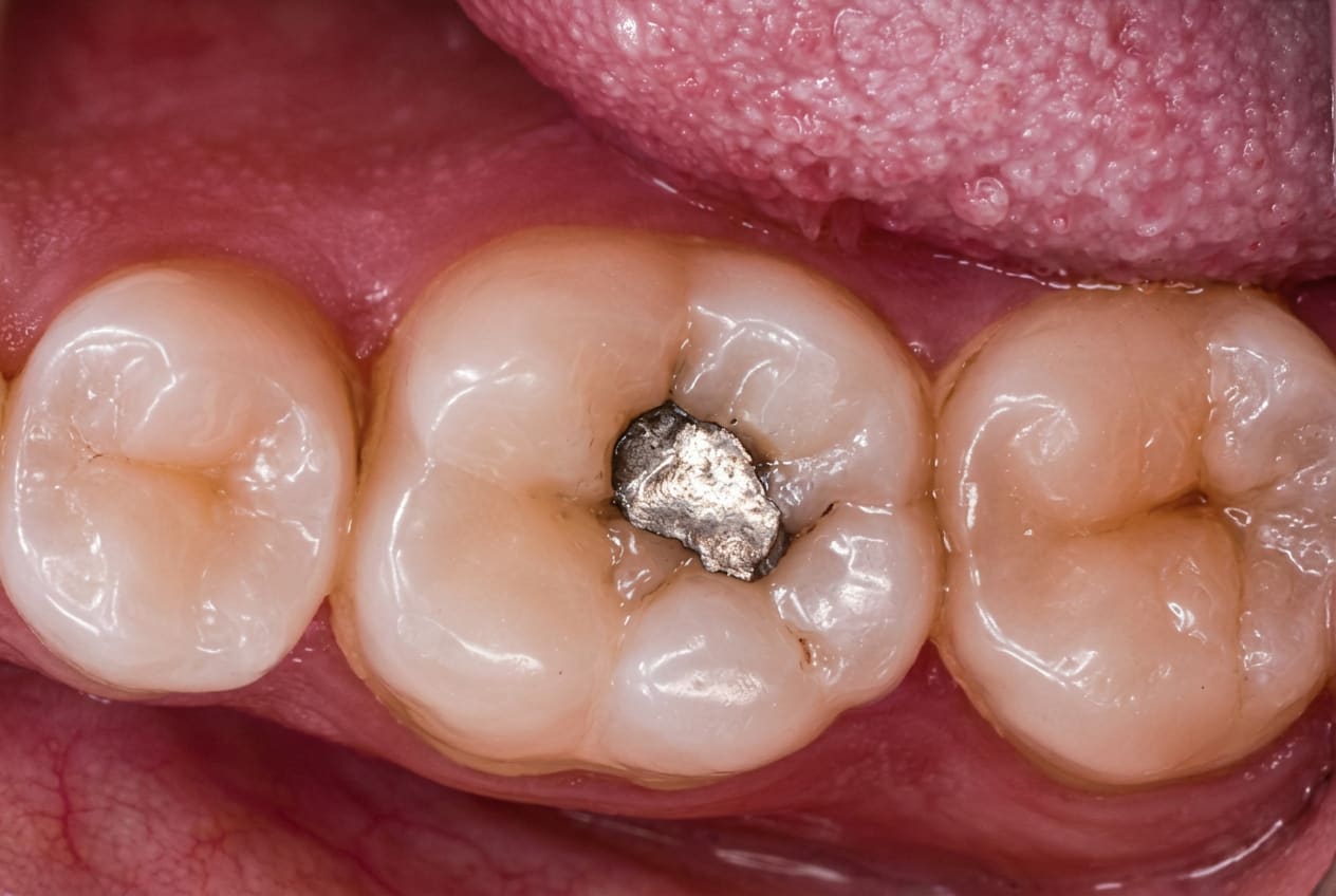 Odontologia Restauradora: substituição de restaurações antigas e de amálgama